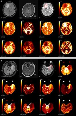 Multiple diffusion metrics in differentiating solid glioma from brain inflammation